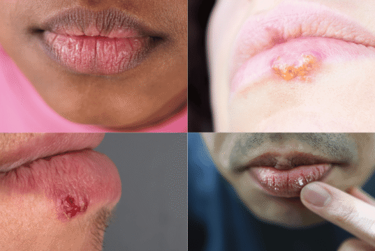 Sun Blister on the Lip: Complete Overview of Causes, Symptoms, Treatment, Prevention, and Recovery Timeline Sun Blister on the Lip