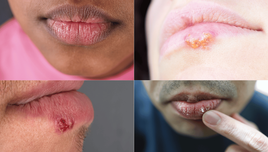 Sun Blister on the Lip Sun Blister on the Lip