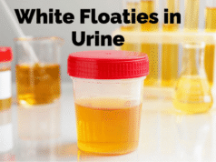 White Floaties in Urine Explained: Causes, Symptoms, Diagnosis, Treatment, and Prevention of Small White Particles in Urine and When They Signal an Underlying Health Condition White Floaties in Urine