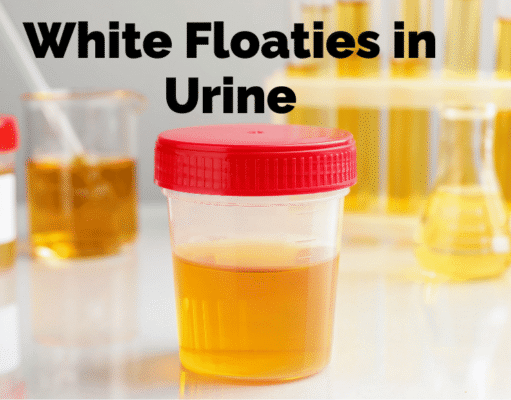 White Floaties in Urine Explained: Causes, Symptoms, Diagnosis, Treatment, and Prevention of Small White Particles in Urine and When They Signal an Underlying Health Condition White Floaties in Urine