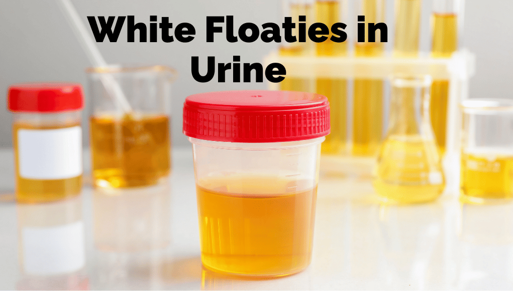 White Floaties in Urine White Floaties in Urine