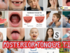 What Is a Posterior Tongue Tie? A Look into the Facts Covering Hidden Symptoms, Long-Term Effects, and Modern Treatment Approaches Posterior Tongue Tie