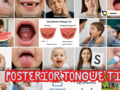 What Is a Posterior Tongue Tie? A Look into the Facts Covering Hidden Symptoms, Long-Term Effects, and Modern Treatment Approaches Posterior Tongue Tie