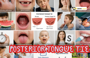 What Is a Posterior Tongue Tie? A Look into the Facts Covering Hidden Symptoms, Long-Term Effects, and Modern Treatment Approaches Posterior Tongue Tie